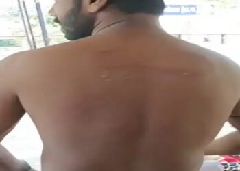 नग्न कर पीटा, फिर चेहरे पर पेशाब किया: पत्नी से छेड़छाड़ का विरोध करने पर मारपीट, 5 युवकों ने लाठी-डंडे और बेल्ट से मारा